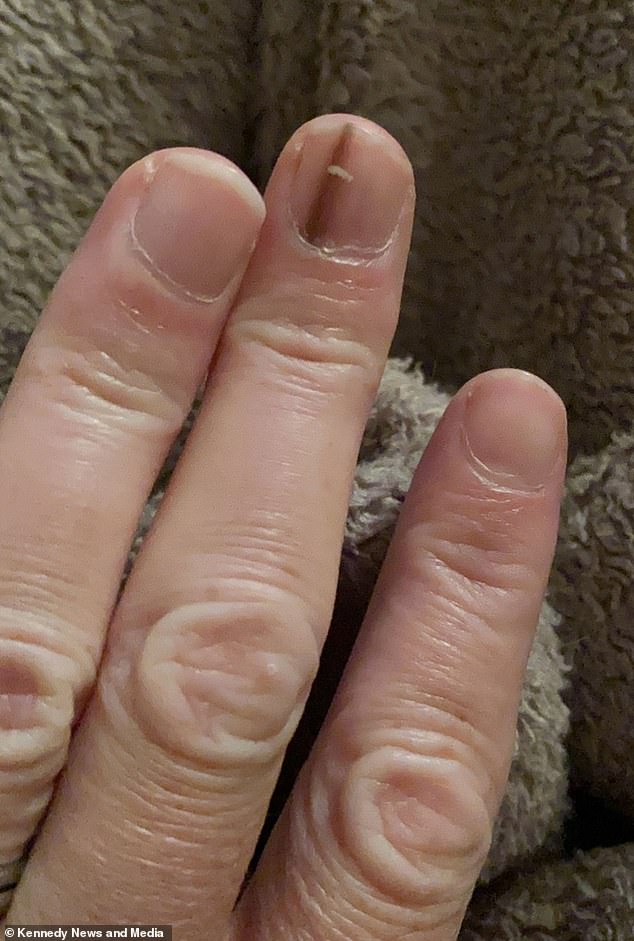 Faint Brown Line Under Fingernail Warns of Deadly Cancer, Experts Urge Vigilance