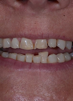 A New Smile, Renewed Confidence: Mandy Turver's Journey with the ABC Technique