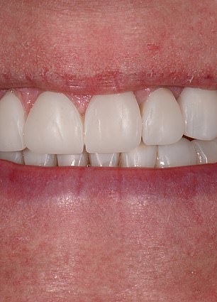 A New Smile, Renewed Confidence: Mandy Turver's Journey with the ABC Technique