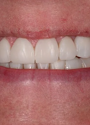 A New Smile, Renewed Confidence: Mandy Turver's Journey with the ABC Technique