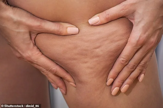 Lipoedema: The Hidden Condition Behind Stubborn Cellulite
