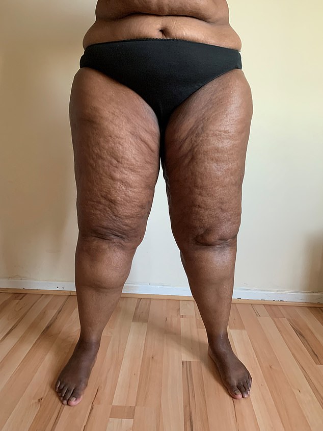 Lipoedema: The Hidden Condition Behind Stubborn Cellulite