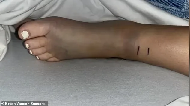 14-Year-Old Girl Survives Venomous Rattlesnake Bite in California Adventure
