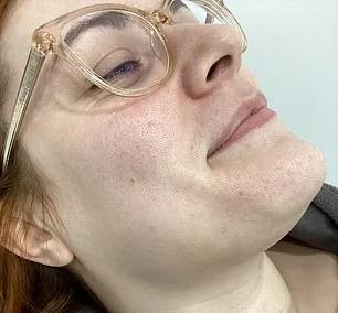 The Hidden Burden of Hirsutism: How PCOS Leaves Women Battling Unwanted Facial Hair and Emotional Struggles