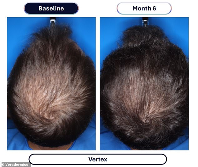 Veradermics' extended-release minoxidil delivers four times the hair regrowth of standard treatments.