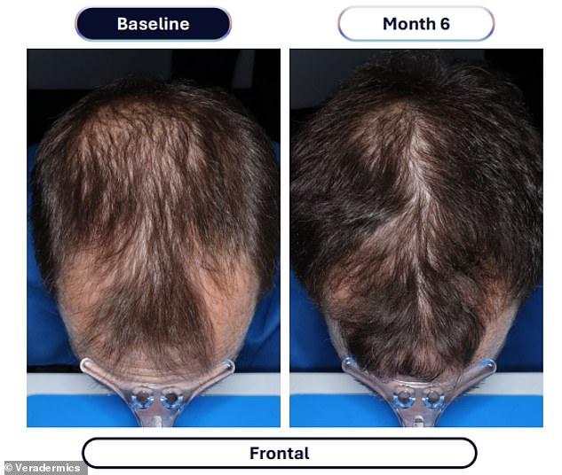 Veradermics' extended-release minoxidil delivers four times the hair regrowth of standard treatments.