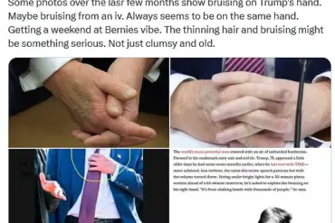 Trump Hand Bruise Sparking Concerns: An Unusual Sight for the President