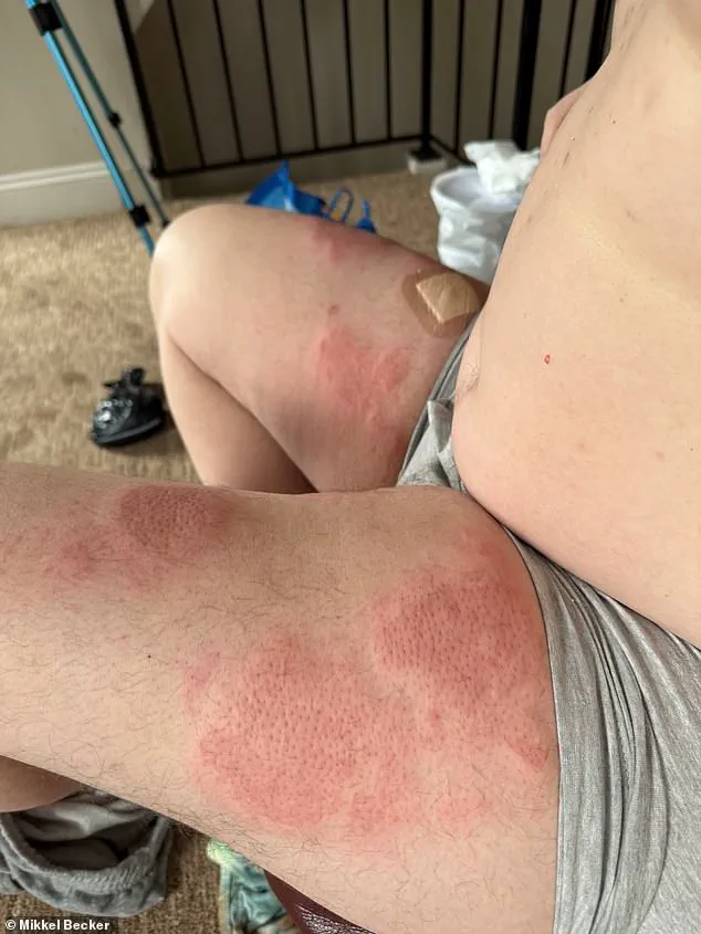Father-of-Six with Ultra-Rare Skin Disease Given Six Months to Live