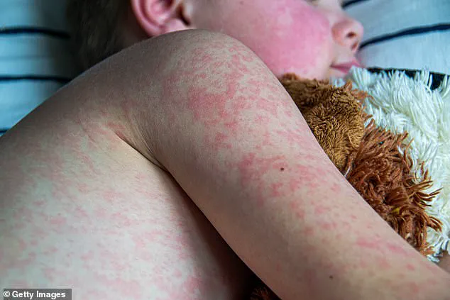 Measles Cases Surpass Last Year's Total in Three Months: CDC Reports Alarming Surge