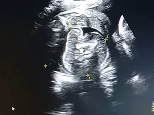 The Mystery of a Pregnant Girl With an Unusual Conception