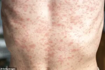 Denver Airport Measles Cases Trigger Urgent Public Health Alert Over Community Exposure