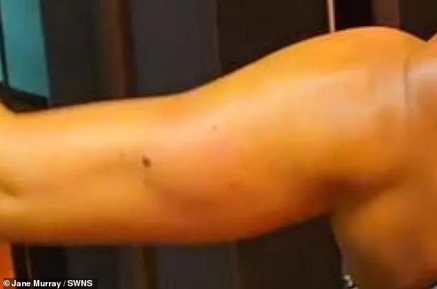 Melanoma Survivor Jane Murray Advocates for Early Detection After Four-Year Delay in Examining Mole
