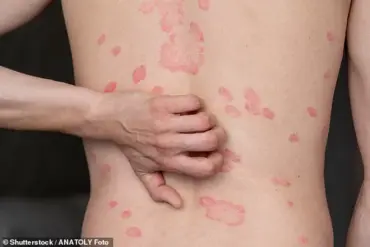 New Study Reveals Link Between Abdominal Fat and Psoriasis Risk, Highlighting Potential for Targeted Prevention Strategies