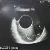 Tunisian Woman Faces Emergency Surgery to Remove Dog-Contracted Hydatid Cyst During Pregnancy