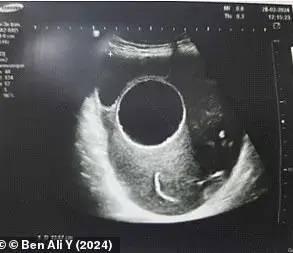 Tunisian Woman Faces Emergency Surgery to Remove Dog-Contracted Hydatid Cyst During Pregnancy