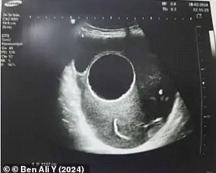 Tunisian Woman Faces Emergency Surgery to Remove Dog-Contracted Hydatid Cyst During Pregnancy