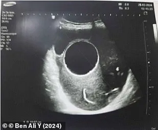 Tunisian Woman Faces Emergency Surgery to Remove Dog-Contracted Hydatid Cyst During Pregnancy