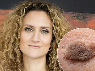 Persistent Thigh Burning: Expert Warns of Nerve-Related Roots Over Simple Solutions