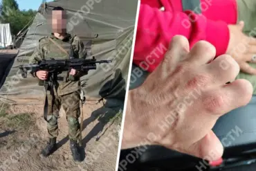 Urgent Exposé: Russian Soldier Deployed to Front Lines Despite Being a Hand Amputee