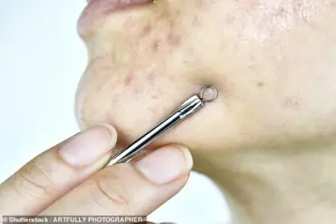 Why Popping Pimples Before Big Events Can Lead to Scars and Costly Medical Interventions, Warns Dermatologist