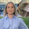 Breaking: Emily Haley's Skin Cancer Legacy and the New Spot That Demands Immediate Action