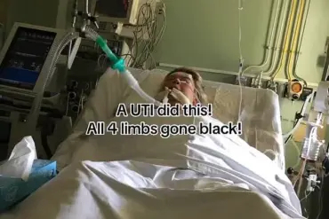 From Routine UTI to Quadruple Amputation: A Cautionary Tale of Untreated Infections and the Perils of Sepsis