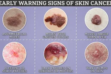 Leading GP Warns Against Dismissing Subtle Skin Changes: New Melanoma Alert from Body Scan Clinic Specialist