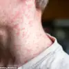 UK Faces Measles Resurgence Crisis as MMR Vaccination Rates Decline and Tragic Liverpool Case Sparks Urgent Calls for Parent Action