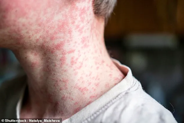 UK Faces Measles Resurgence Crisis as MMR Vaccination Rates Decline and Tragic Liverpool Case Sparks Urgent Calls for Parent Action