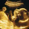 AI Advances in Prenatal Care: 95% Accuracy in Predicting Due Dates Challenges Traditional Methods