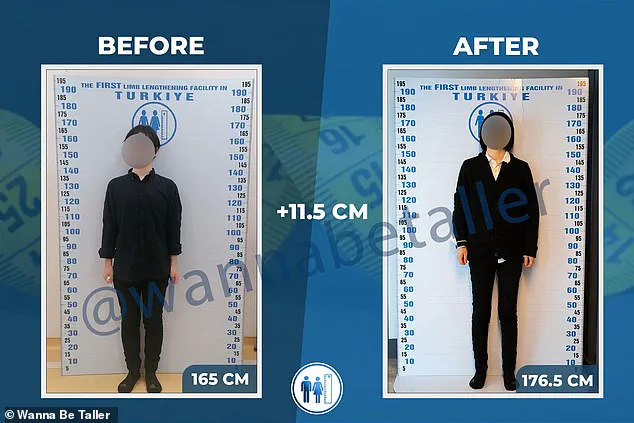 Pedro Pascal's 'Materialists' Reveals the Societal Impact of Leg Lengthening Procedures