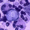 Tragedy of a Young Life Lost to Rare Brain-Eating Amoeba Sparks Renewed Health Warnings