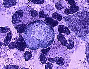 Tragedy of a Young Life Lost to Rare Brain-Eating Amoeba Sparks Renewed Health Warnings