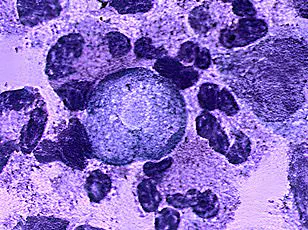 Tragedy of a Young Life Lost to Rare Brain-Eating Amoeba Sparks Renewed Health Warnings