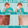 Urgent Call to Vaccinate Children as Measles Cases Surge in England, Reaching Highest Levels Since 2012