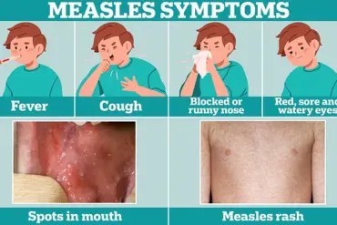 Urgent Call to Vaccinate Children as Measles Cases Surge in England, Reaching Highest Levels Since 2012