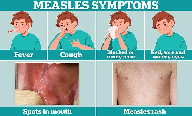 Urgent Call to Vaccinate Children as Measles Cases Surge in England, Reaching Highest Levels Since 2012