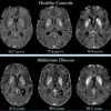 Late-Breaking Discovery: Johns Hopkins Unveils Advanced MRI Technique to Predict Dementia Years Before Symptoms