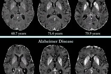 Late-Breaking Discovery: Johns Hopkins Unveils Advanced MRI Technique to Predict Dementia Years Before Symptoms