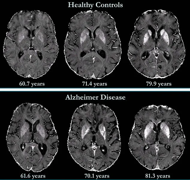 Late-Breaking Discovery: Johns Hopkins Unveils Advanced MRI Technique to Predict Dementia Years Before Symptoms
