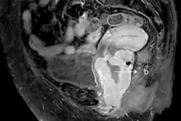 Overlooked Symptoms Lead to Fatal Outcomes in Post-Menopausal Women